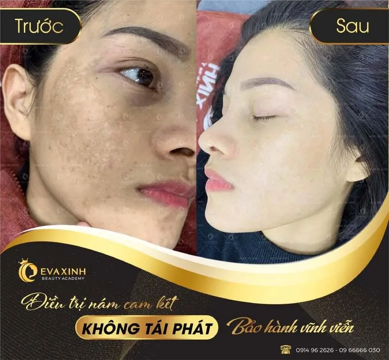 Khách điều trị nám tại Thẩm mỹ viện Eva Xinh